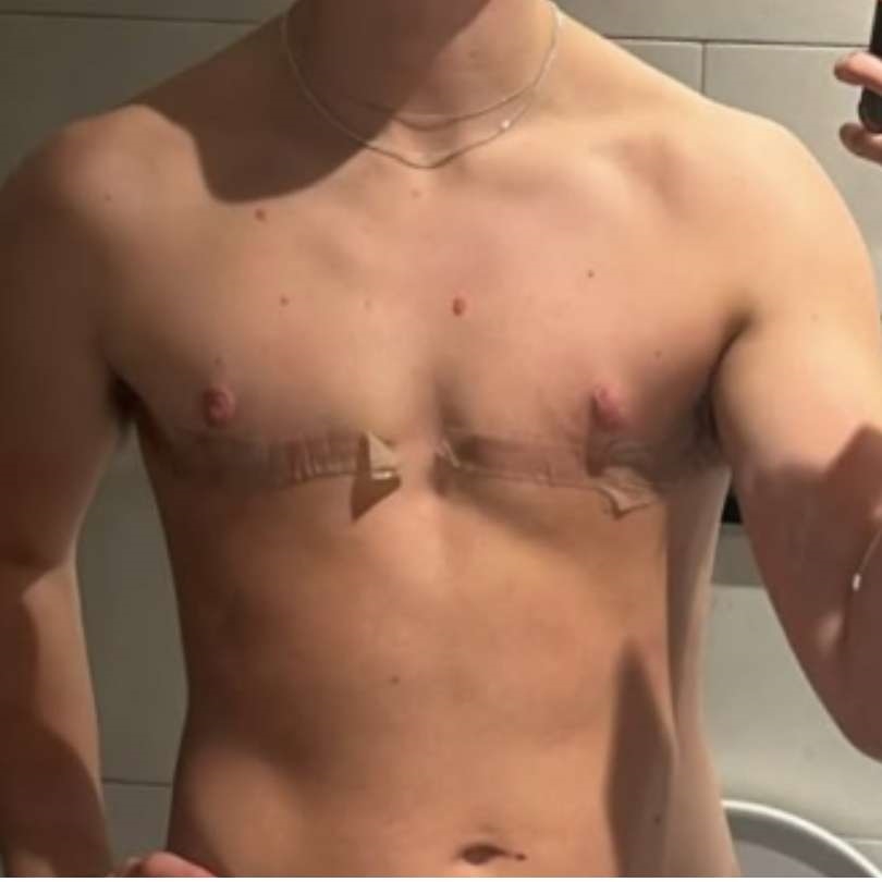 Gender Affirmation Patient After Gender Affirmation Patient After